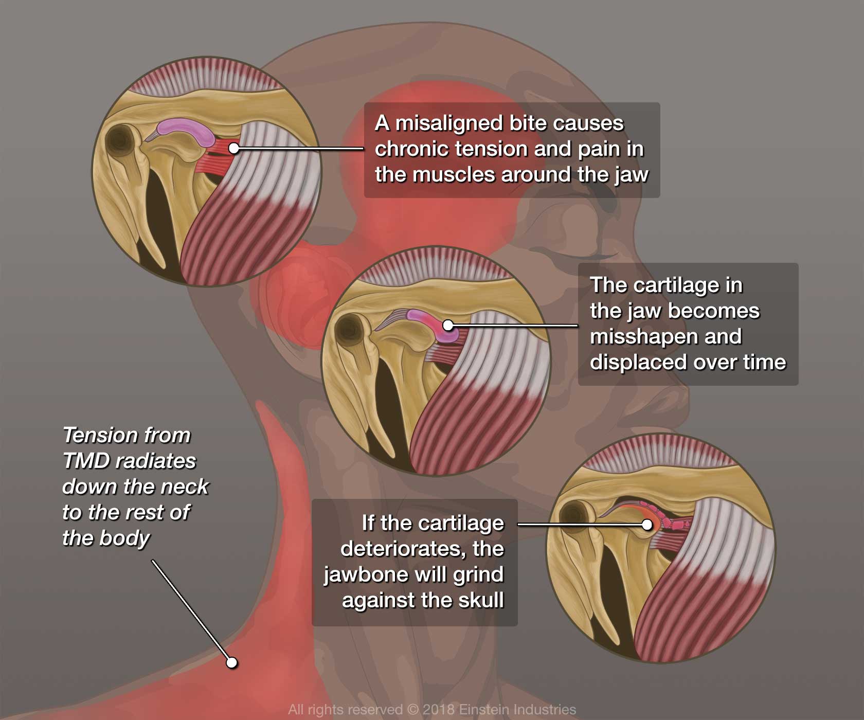 Diagram of how TMJ can radiate down the neck to the whole body, create chronic tension and pain in the jaw's muscles, becomes misshapen and displaced over time, and will grind against the skull if cartilage deteriorates